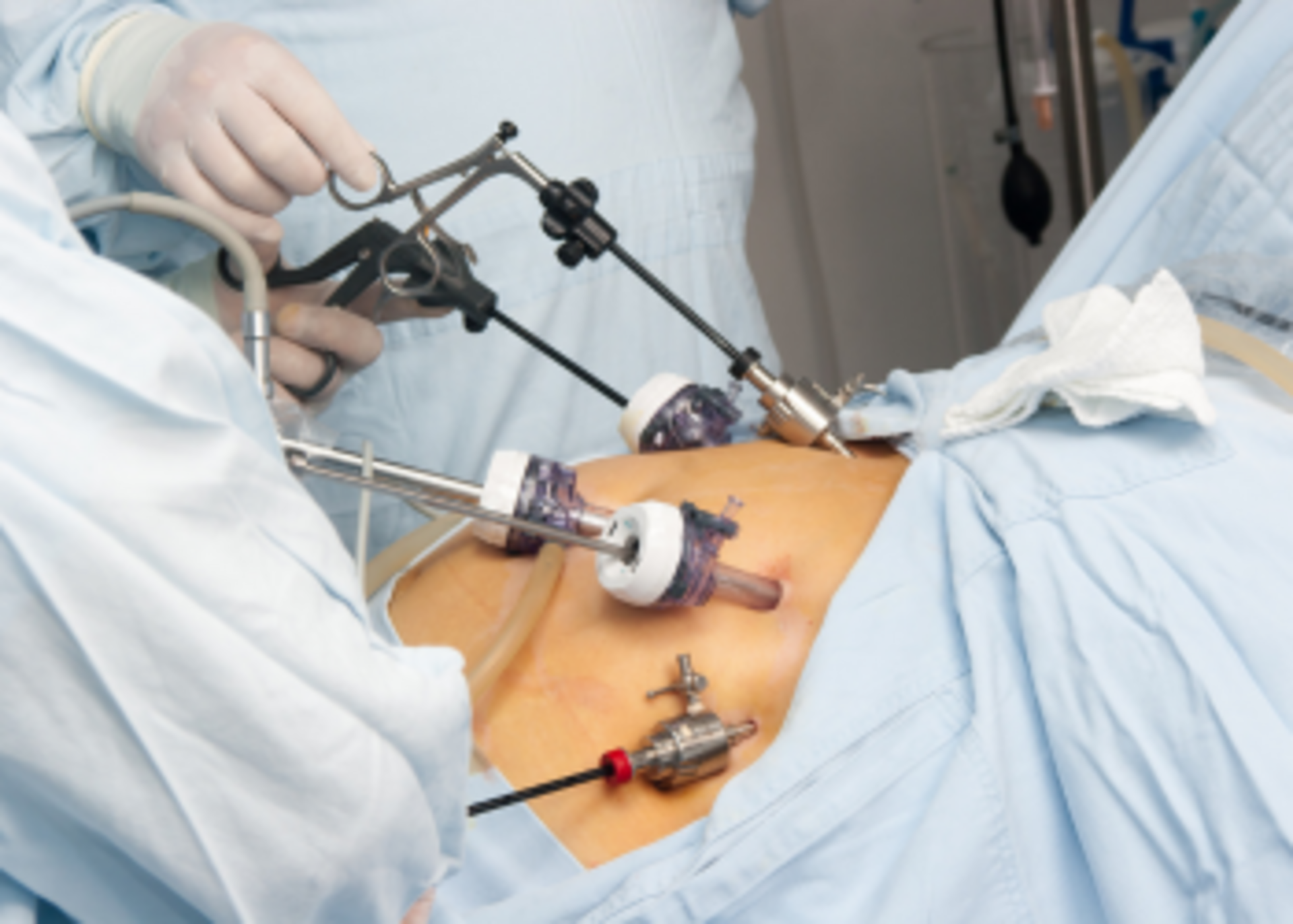 Laser Stone Surgery